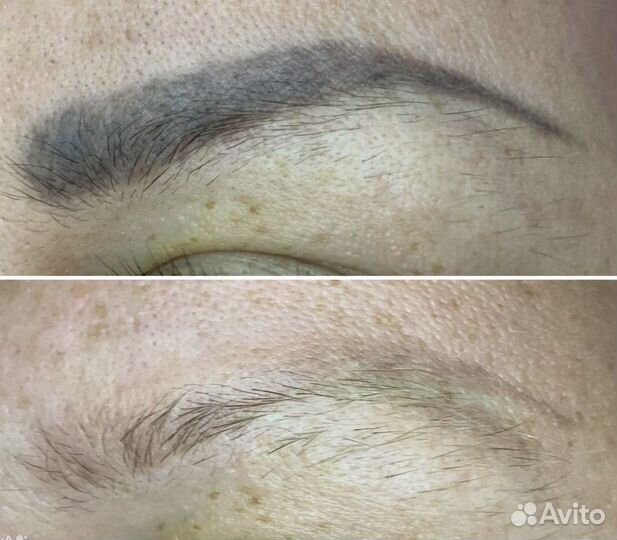 Удаление татуажа и тату лазер / ремувер