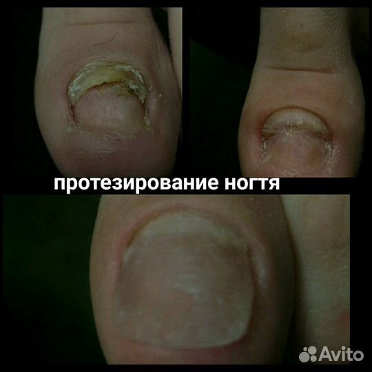 Подолог. медицинский педикюр. Г. Королёв