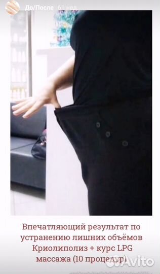 Криолиполиз, LPG, прессотерапия