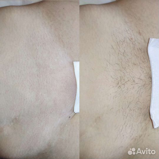 Депиляция воском: глубокое бикини