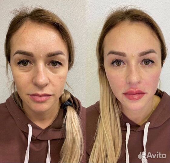 Косметолог губы, мезо, ботокс