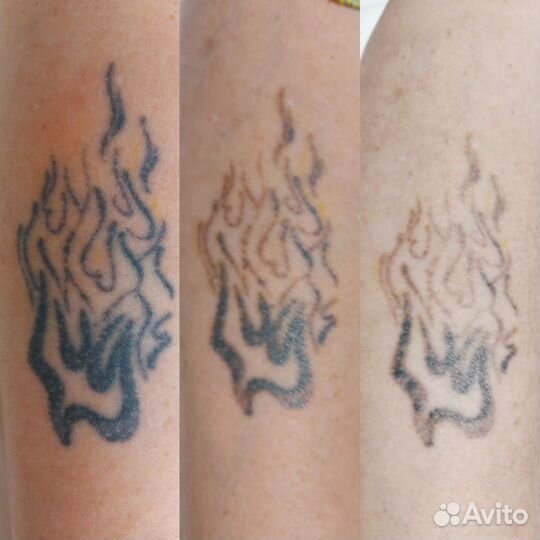 Удаление татуажа бровей лазером