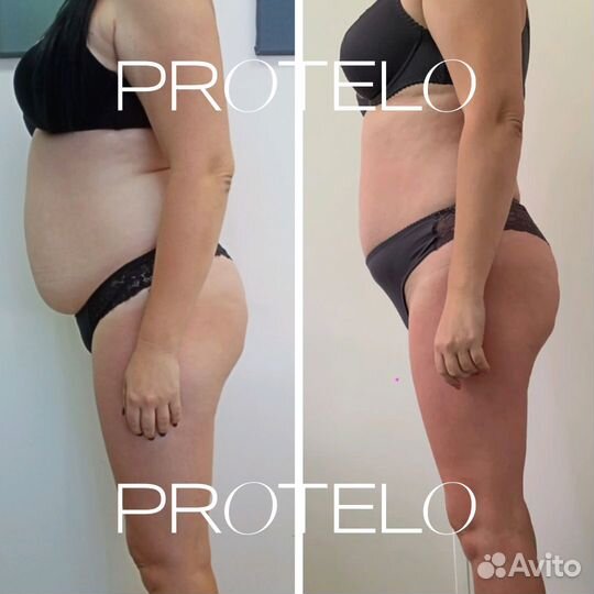 LPG, аппаратный массаж, коррекция фигуры