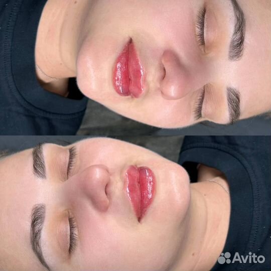 Увеличение губ