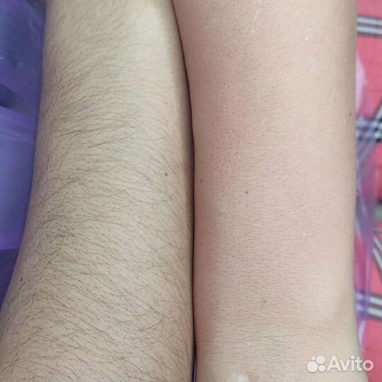 Шугаринг эпиляция