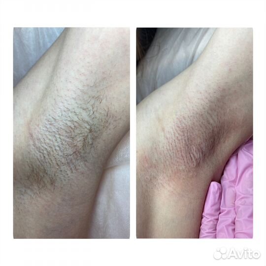 Электроэпиляция