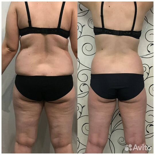 Коррекция фигуры, LPG массаж, RF лифтинг