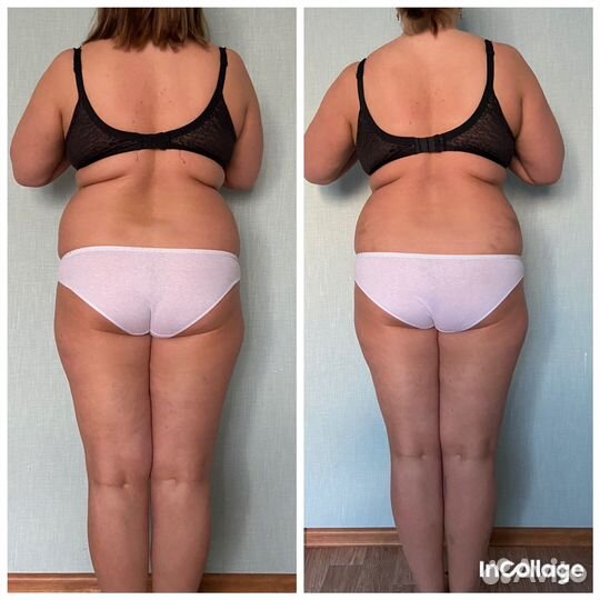 Антицеллюлитный массаж