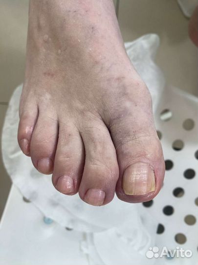 Педикюр подолог