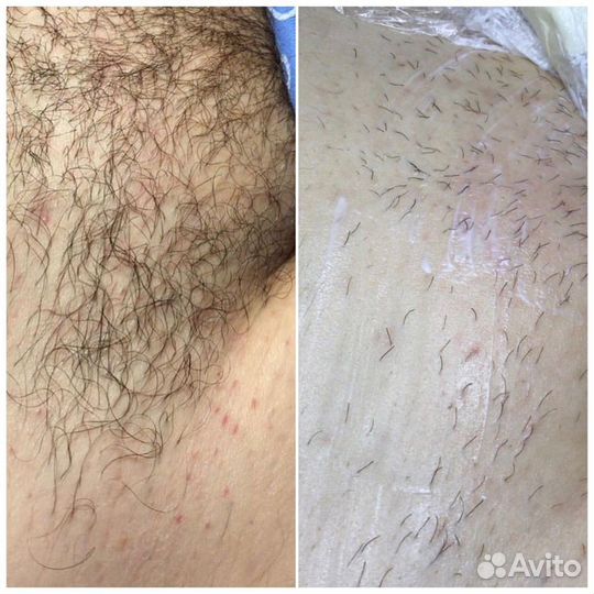 Электроэпиляция удаление волос навсегда