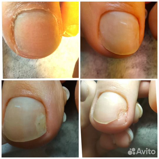 Подолог. Медицинский педикюр.Сергиев Посад