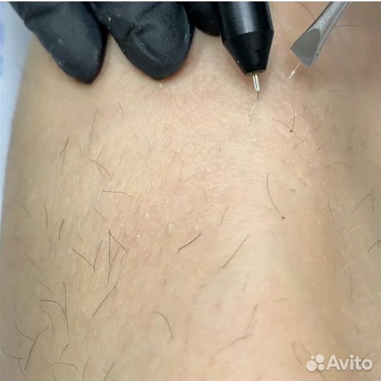 Электроэпиляция - Лазерная эпиляция