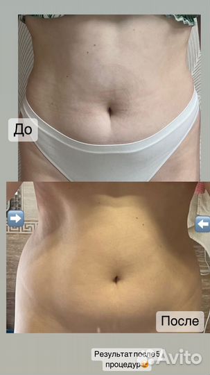 Аппаратная коррекция фигуры