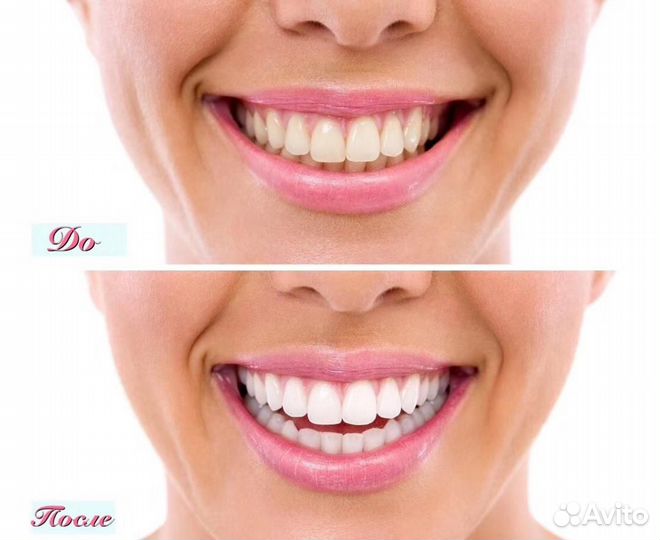 Отбеливание зубов дома Led капа, гель Deluxe White