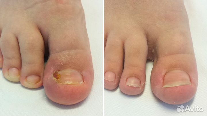 Медицинский педикюр - Подолог