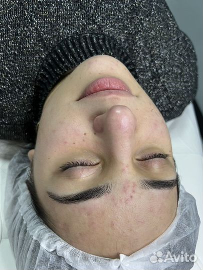 Чистка лица с пилингом