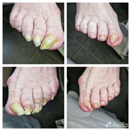 Подолог. Педикюр