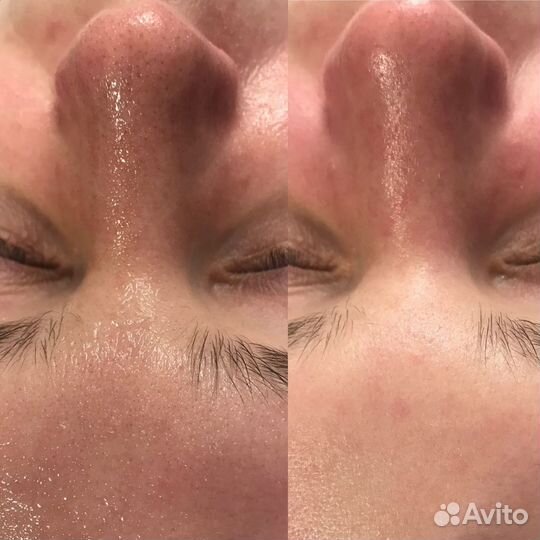 Чистка лица