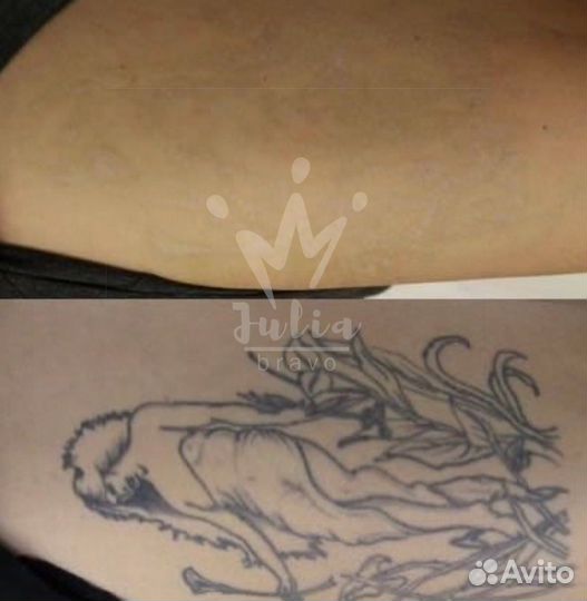 Лазерное удаление тату и татуажа