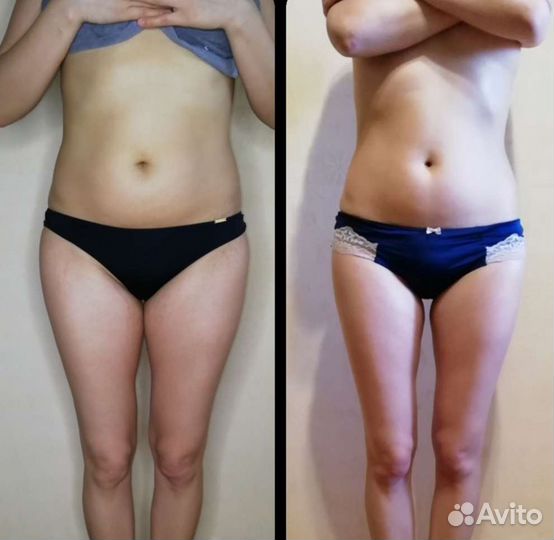 Антицеллюлитный массаж