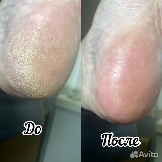 Педикюр,Smart-педикюр,обработка стопы