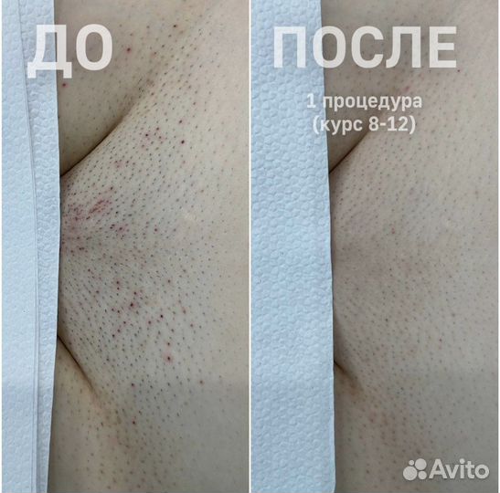 Лазерная эпиляция