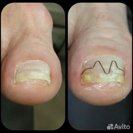 Подолог. медицинский педикюр. Г. Королёв