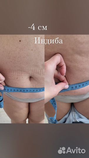 Аппаратный массаж. LPG