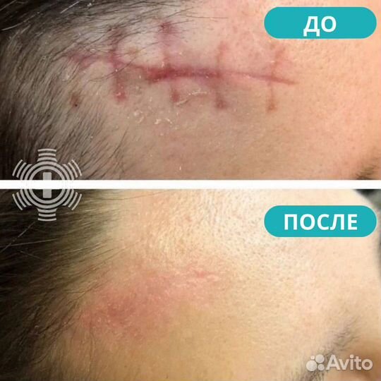 Плазмолифтинг от рубцов и шрамов