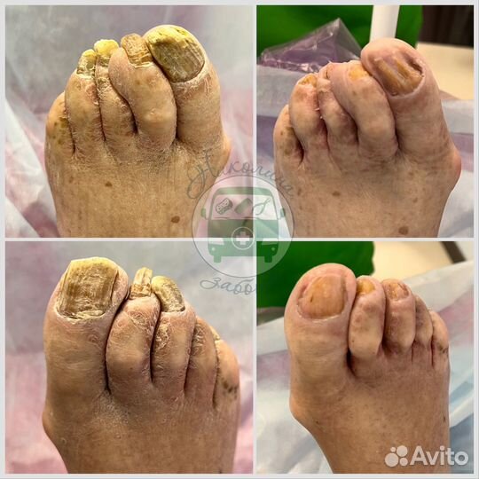 Парамедицинский педикюр пожилым с выездом на дом