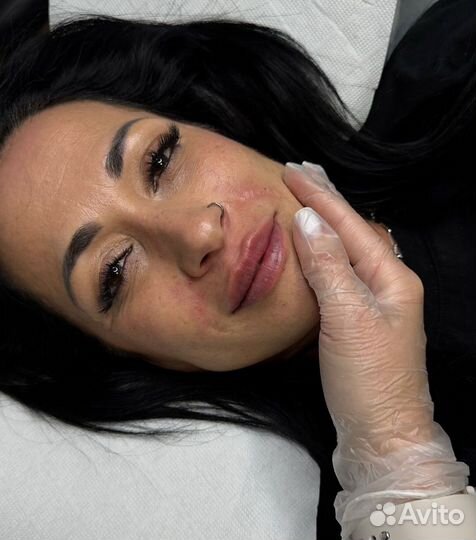 Увеличение Губ