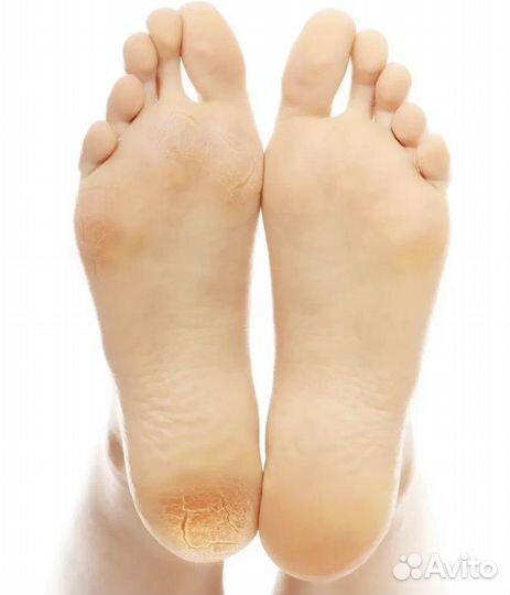 Педикюр,Подолог. Протезирование ногтей