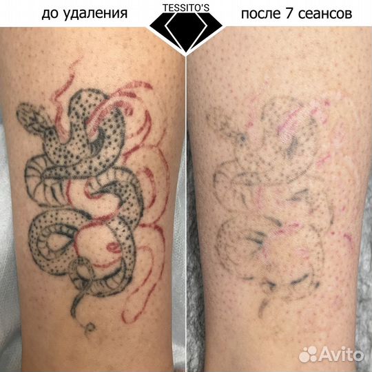 Удаление тату