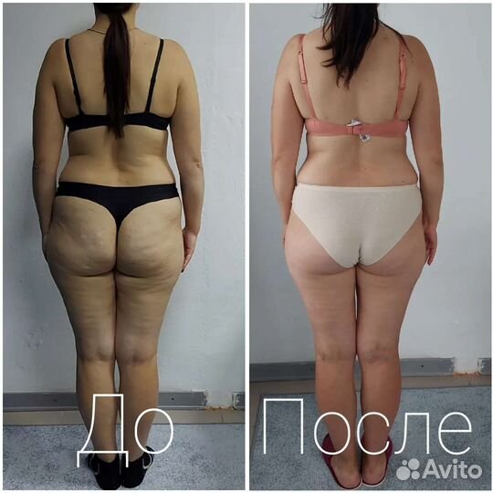 Мастер LPG массажа