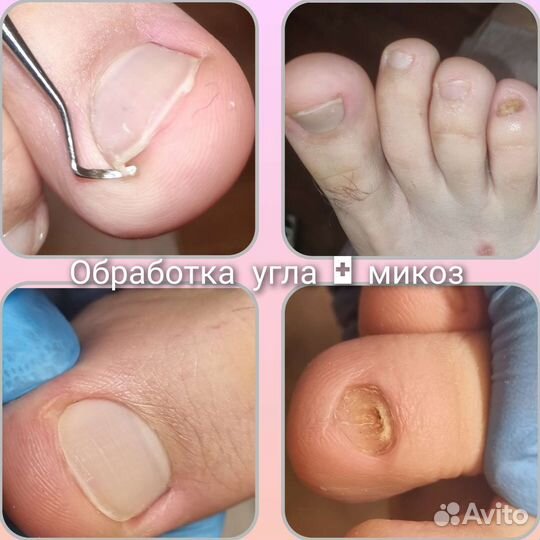 Педикюр, подолог