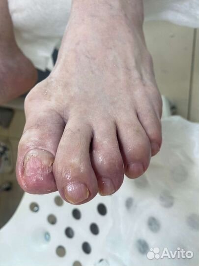 Педикюр подолог