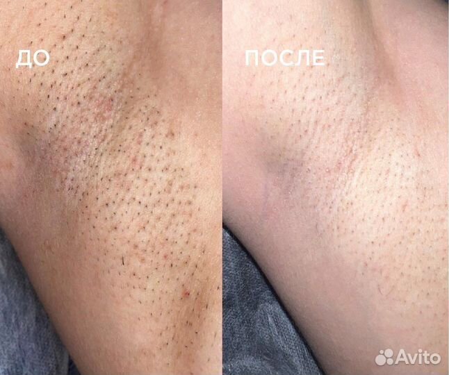 Лазерная эпиляция