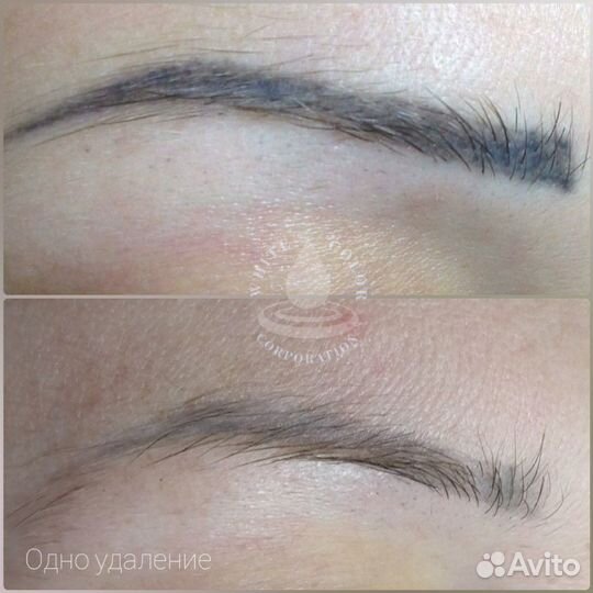 Удаление татуажа, татуировок