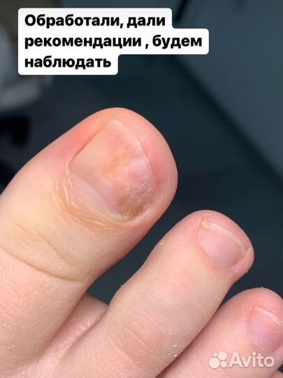 Подолог,трещины,вросший,бородавки,мозоли,микоз