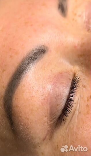 Блефаропластика