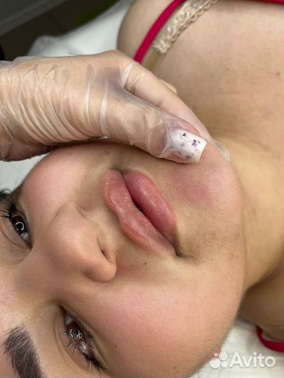 Увеличение губ