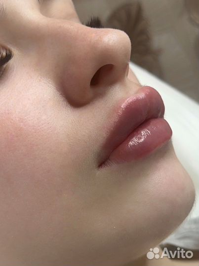 Увеличение губ