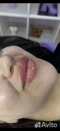 Увеличение Губ