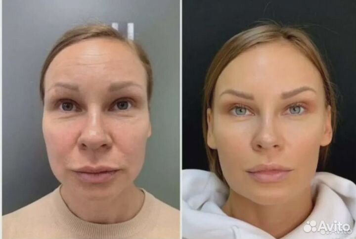 Смас лифтинг, Криолиполиз