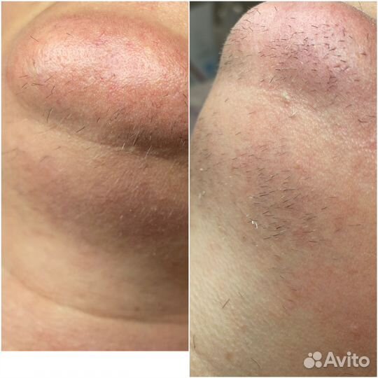 Электроэпиляция