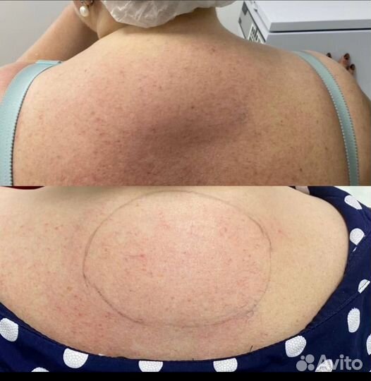 Удаление жировых отложений инъекционная процедура