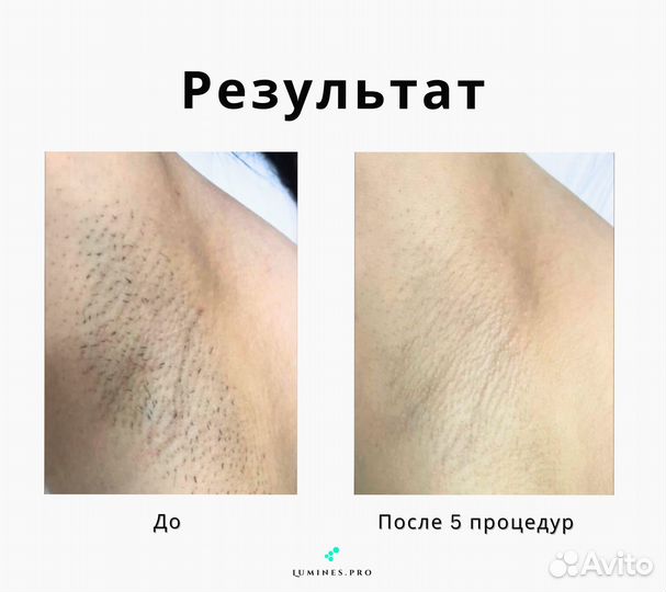 Диодный лазер люминес Max One 1200