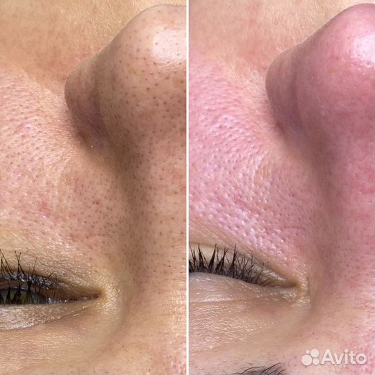 Чистка лица