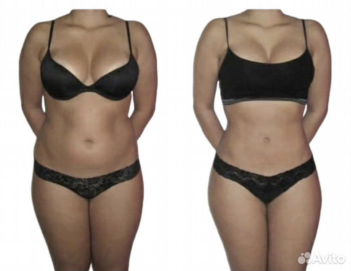 Аппаратная липосакция, liposfera