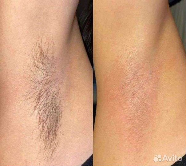 Депиляция воском: глубокое бикини